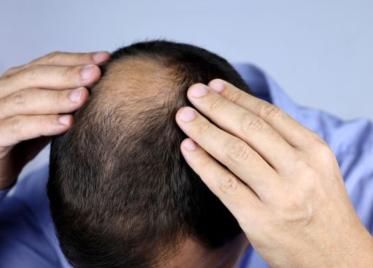 Cause della caduta dei capelli nell’uomo 