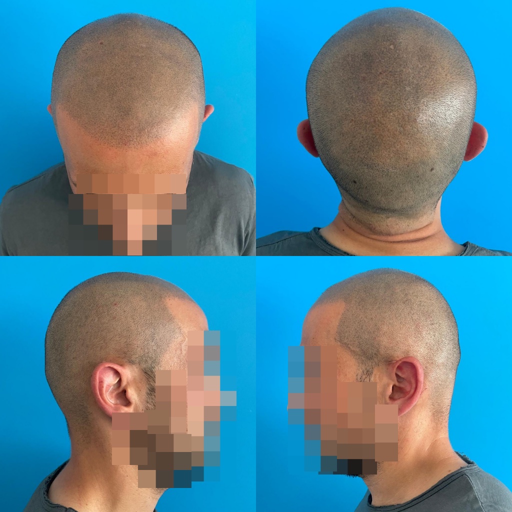 Tricopigmentazione - Prima e Dopo - Tricopigmentazione - Prima e Dopo
