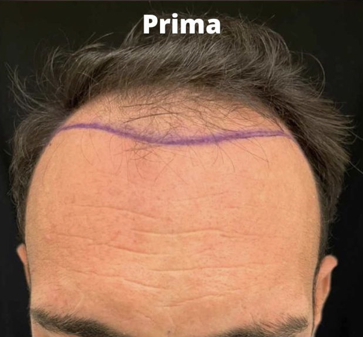 Prima e dopo il trapianto di capelli