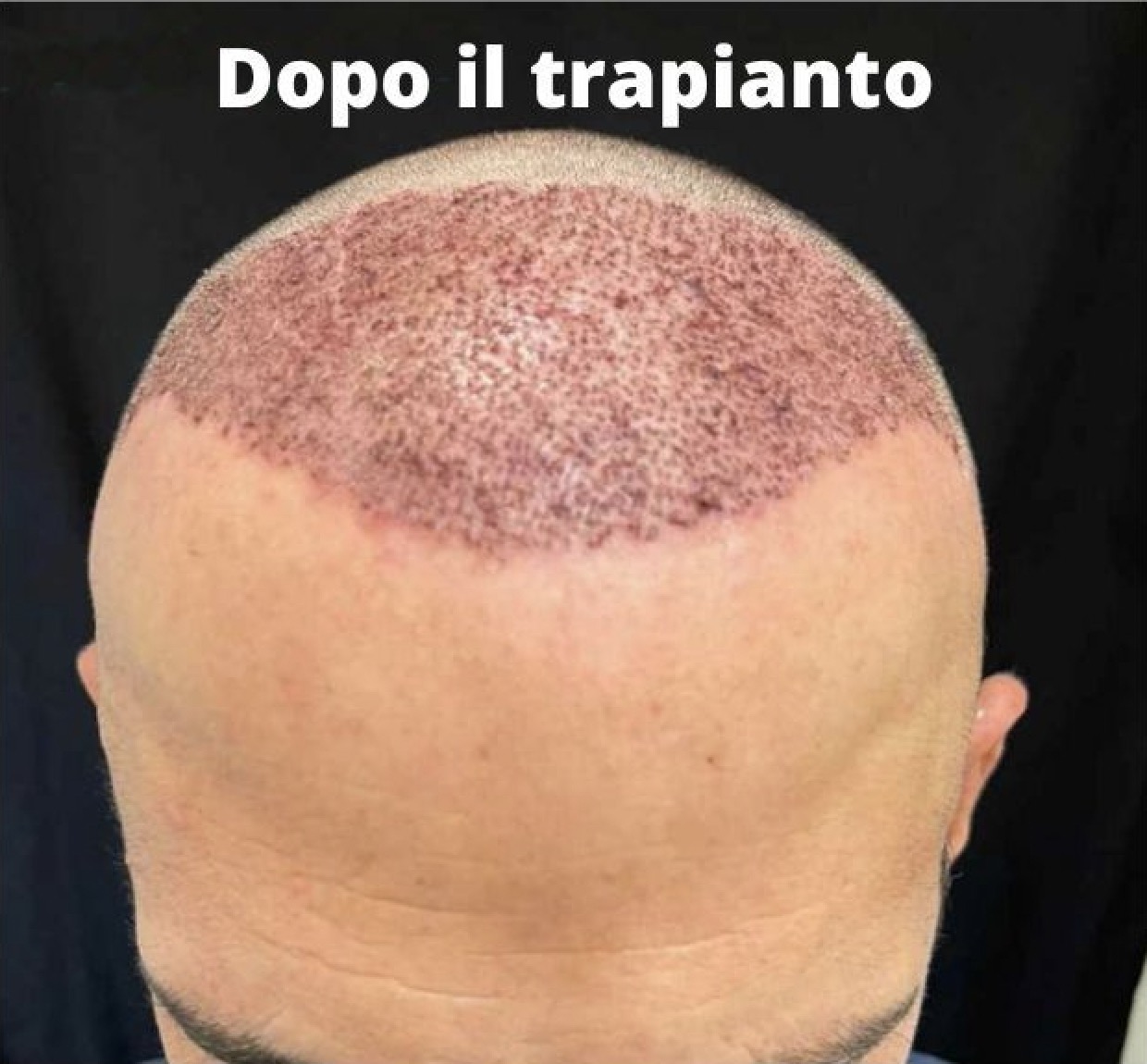 Prima e dopo il trapianto di capelli