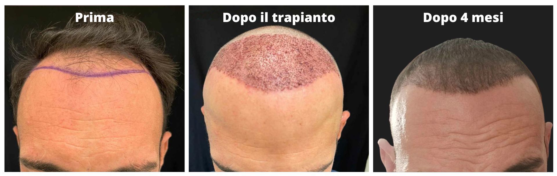 Prima e dopo il trapianto di capelli