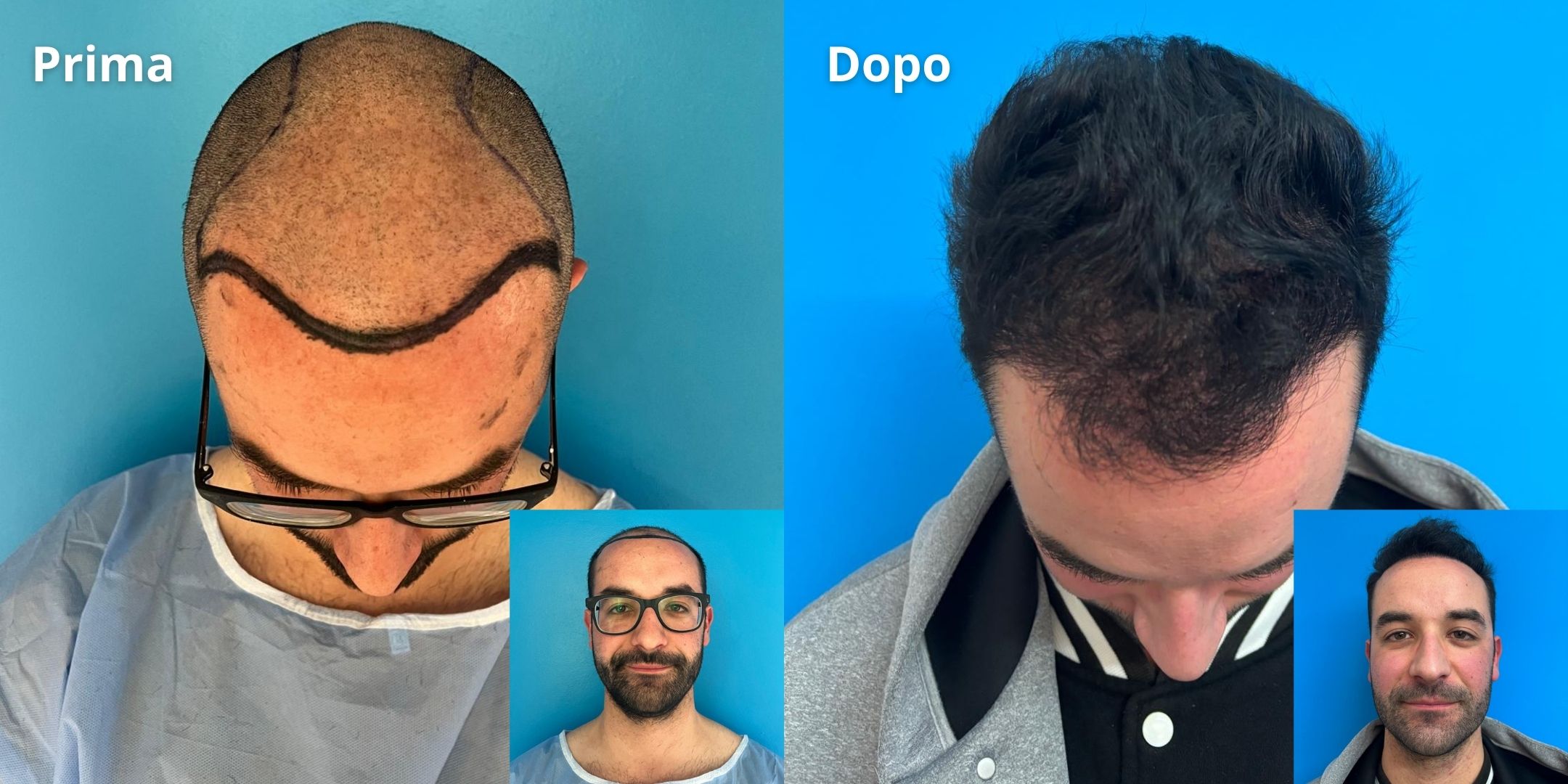 Prima e Dopo Trapianto di Capelli 