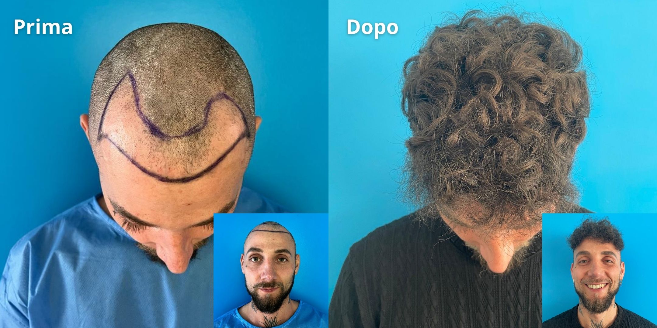 Prima e Dopo Trapianto di Capelli