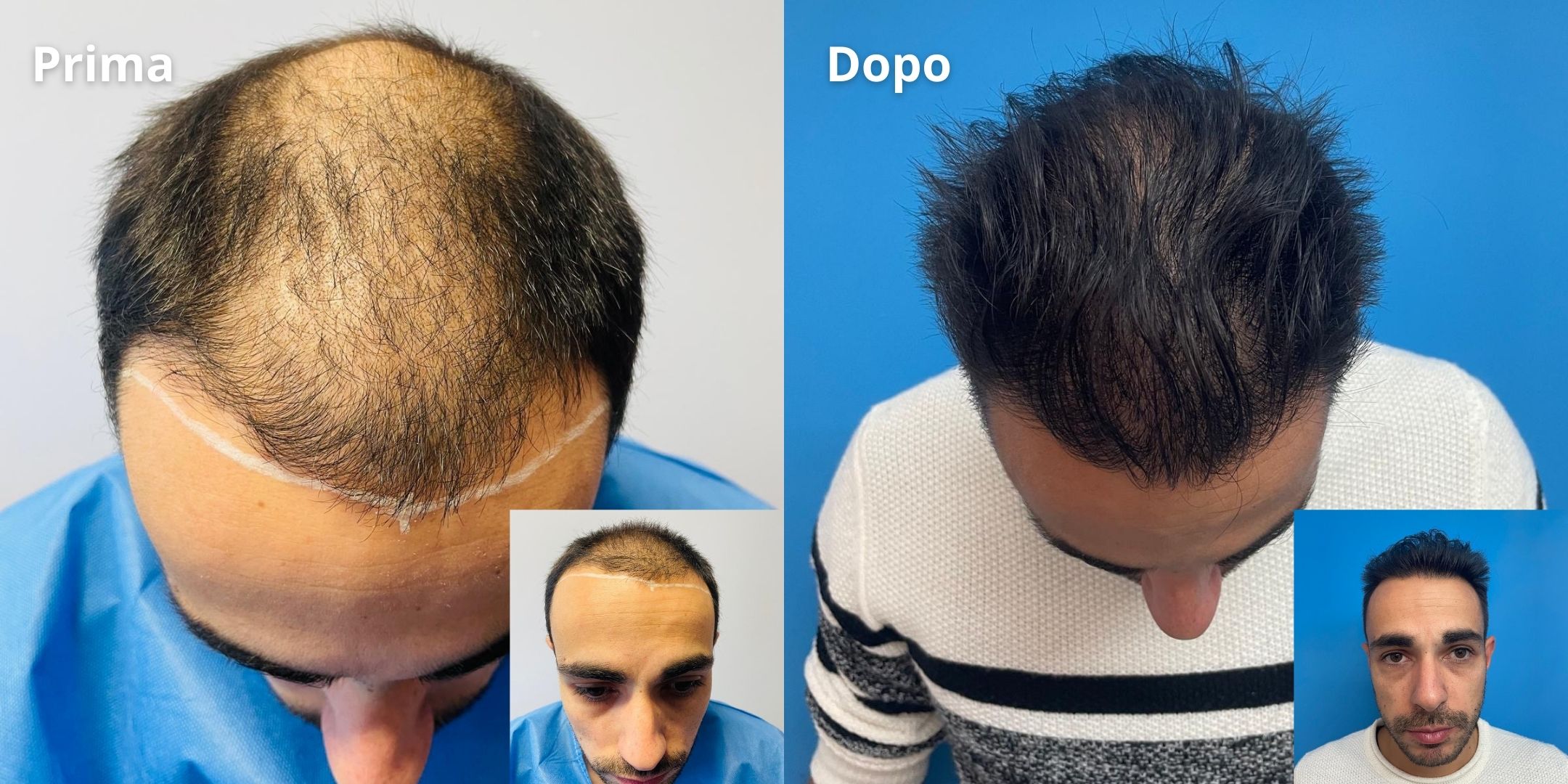 Prima e Dopo Trapianto di Capelli