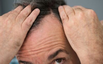 A che età si può fare il trapianto di capelli: pro, contro e nuove tecniche